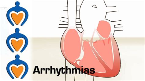 Arrhythmia What Is Causes Symptoms And Treatment