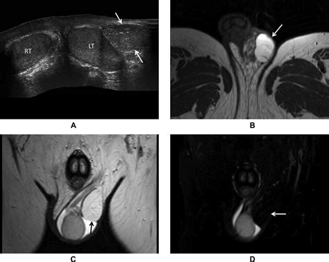 Imaging Features Of Paratesticular Masses Secil 2017 Journal Of