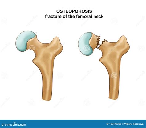 Femoral Neck Fracture Types Of Hip Fractures Subtrochanteric