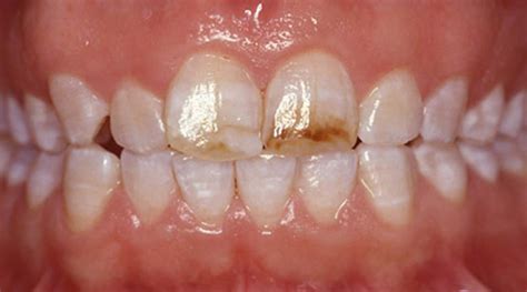 Comprendre Les Variations De Couleur Des Dents Et Taches Dentaires