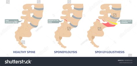 10 Retrolisthesis 이미지 스톡 사진 및 벡터 Shutterstock