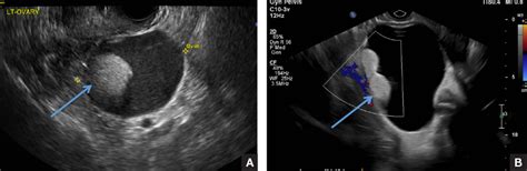 The Many Faces Of Dermoid Mdedge Obgyn