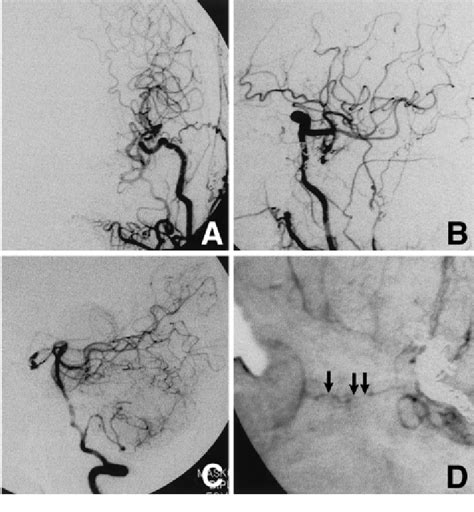 A B Postoperative Left Carotid Angiograms Showing Complete