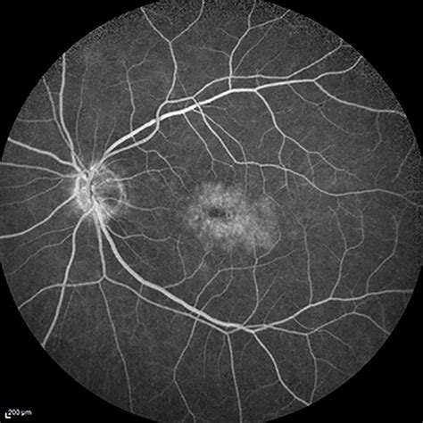 Cystoid Macular Edema Highland Retina Associates Terre Haute Indiana