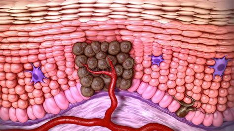 3d Medical Illustration Of Skin Cancer Squamous Cell Carcinoma Basal