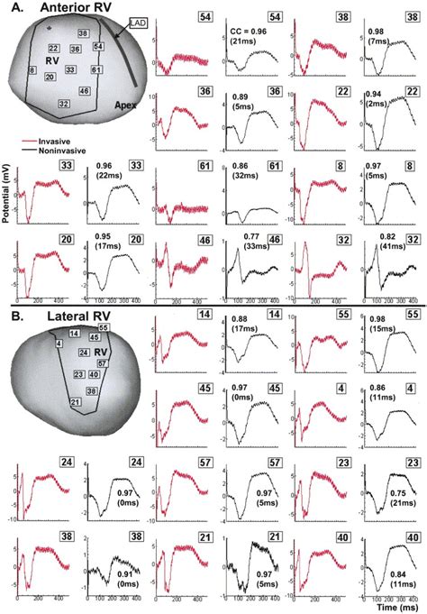 Noninvasive Electrocardiographic Imaging Ecgi Comparison To