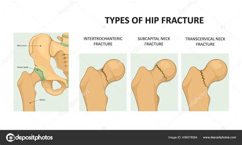 Types Of Hip Fracture Femoral Neck Fracture Medical Vector