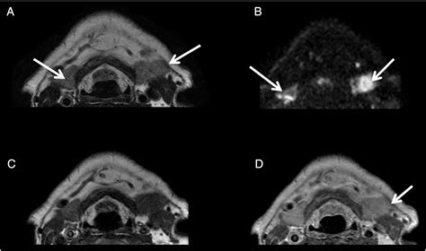 IgG4 Related Systemic Disease Affecting The Parotid And Submandibular