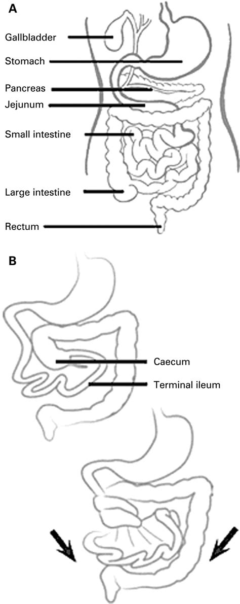 Bile Stained Vomiting In The Infant Green Is Not Good Adc Education