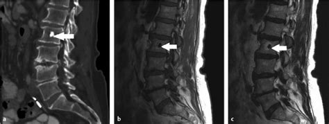 Benign Spinal Tumors Neupsy Key