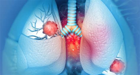 Wie Sich Lungenkrebs Bei Europ Ern Und Asiaten Unterscheidet