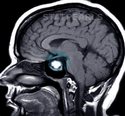 [figure Prolactinoma Mri Image Courtesy S Bhimji Md] Statpearls