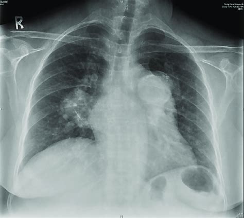 Chest X Ray Revealed A Dilated Right Atrium Dilated Calcified Main