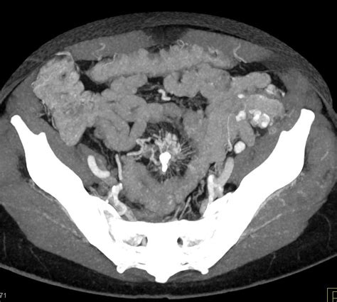 Carcinoid Tumor In Root Of Mesentery With Desmoplastic Reaction And