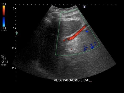 Patent paraumbilical vein on ultrasound: not always cirrhosis ...