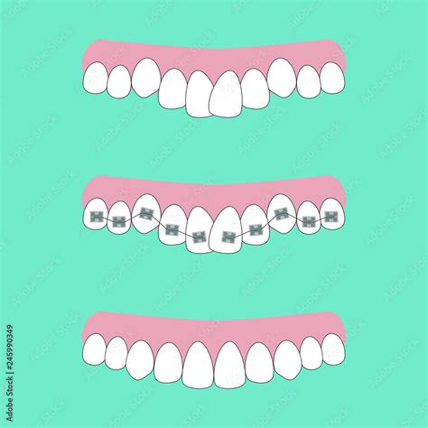 Vector Illustration Of The Stages Of Orthodontic Treatment Braces On