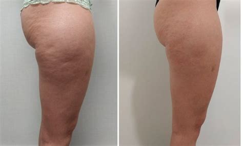 Qu Es Mejor La Mesoterapia O Carboxiterapia Cl Nica Londres