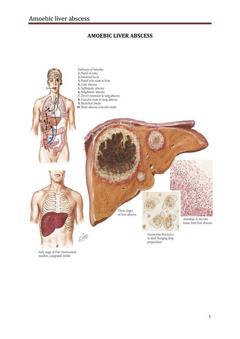 Amoeric Liver Abscess Git Surgery Amoebic Liver Abscess Incidence Complications 1