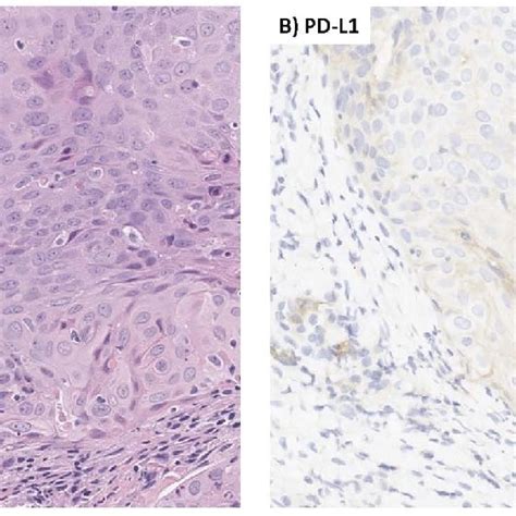 Hematoxylin And Eosin Stain Pd L1 Immunohistochemical Stain A Hande