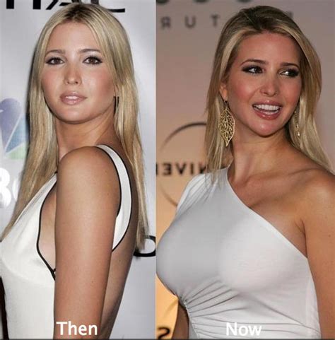 Ivanka Trump Plastic Surgery Before And After Photos