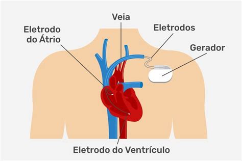 Marcapasso o que é para que serve e quando é indicado Tua Saúde