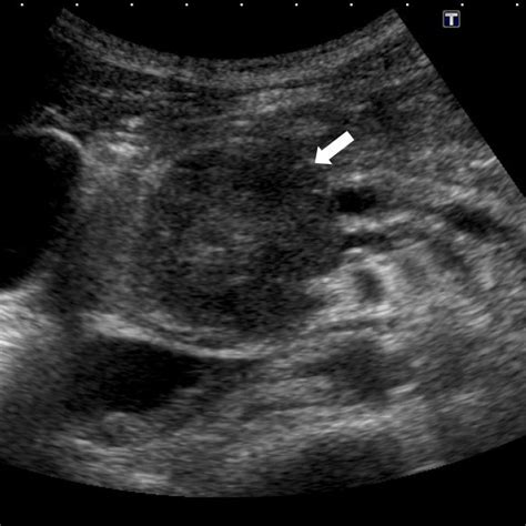 Abdominal Ultrasonography Shows A Well Defined Circular Hypoechoic