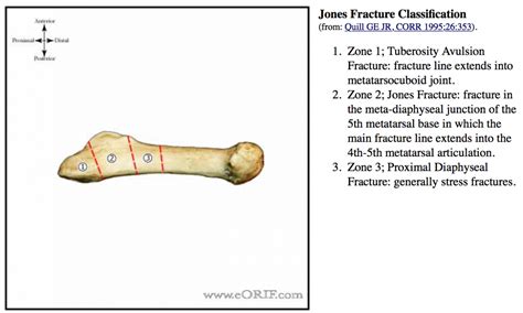 Jones Fracture Orif 28485 Eorif
