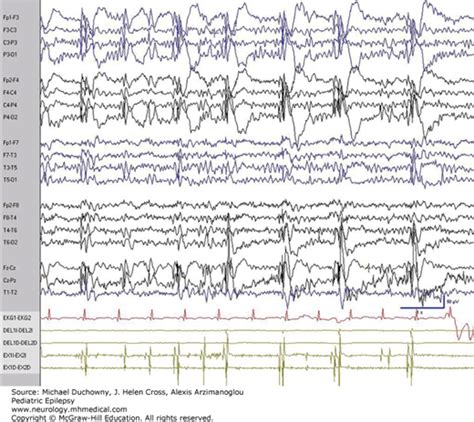 Juvenile Myoclonic Epilepsy | Neupsy Key