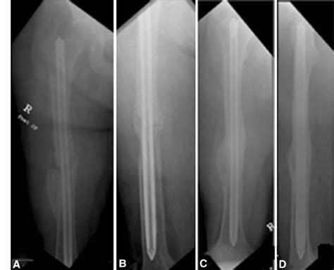 A D A Anteroposterior And B Lateral Radiographs Are Shown After