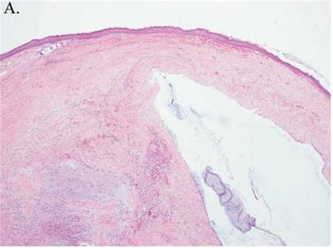 Histologic Features Of Ganglion Cyst The Overlying Epithelium Of The Download Scientific