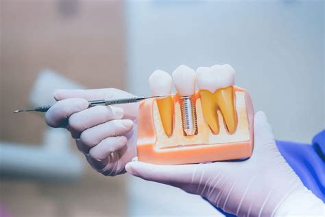 How Much Do Dental Implants Cost Dr Mahsa Esfandiari Dental Group