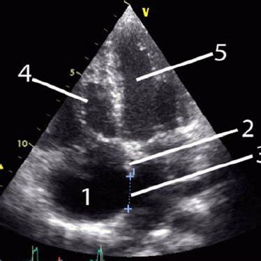 Subcostal four-chamber echocardiographic view. 1 right atrium, 2... | Download Scientific Diagram