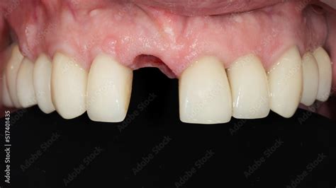 Installed Dental Implant Of The Central Tooth Without A Crown On A