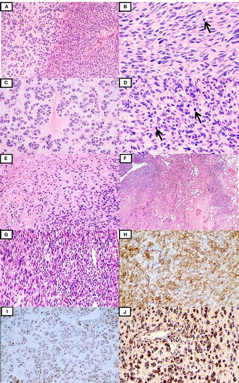 Frontiers Case Report Alk Rearranged Spindle And Epithelioid Cell