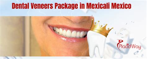 Top Dental Veneer Packages in Mexicali, Mexico