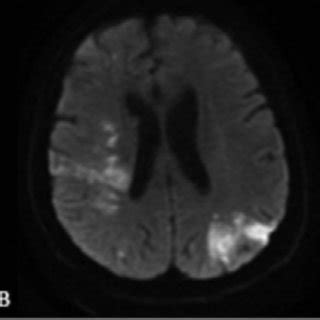 A Cerebral Diffusion Magnetic Resonance Imaging MRI Ischemic