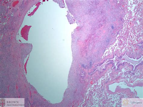 Langerhans Cell Histiocytosis Pathology Residency And Fellowship