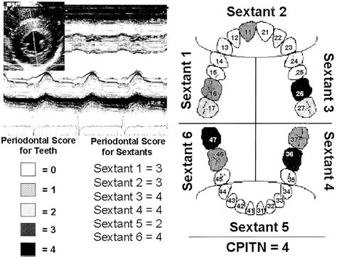 Association Between Periodontal Disease And Left Ventricle Mass In