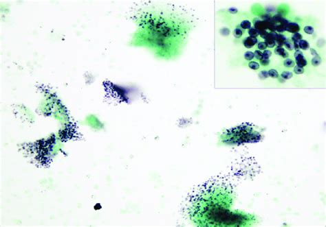 Clusters Of Pneumocystis Jirovecii Cysts Grocott Gomori Methenamine Download Scientific