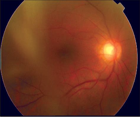 Figure From Natural Killer T Cell Lymphoma Of Nasal Type With