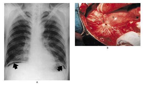 Perforated Duodenal Ulcer