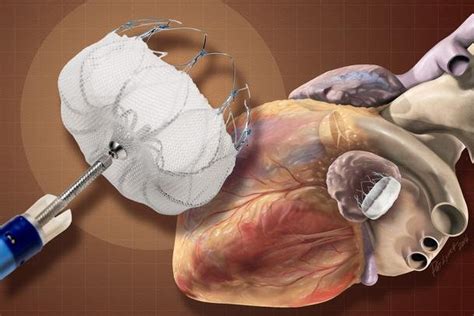 Device May Be Better Than Drugs For Irregular Heartbeat