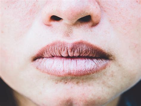 Anemia Lips