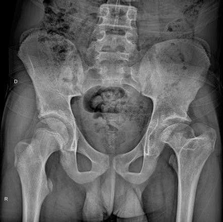 Perthes Disease Radiology Case Radiopaedia Org