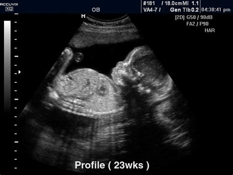 Fetus 23 Weeks B Mode Echogramm №296