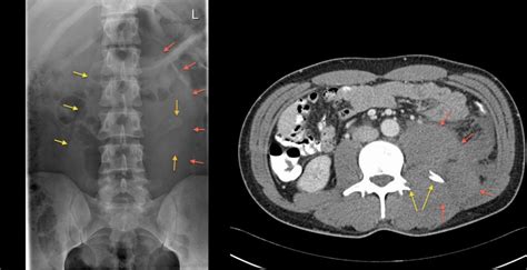 Retroperitoneal Haemorrhage Pfa Ct Radiology At St Vincents