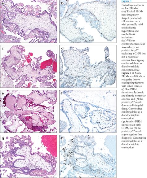 Hydatidiform Moles Genetic Basis And Precision Diagnosis Semantic