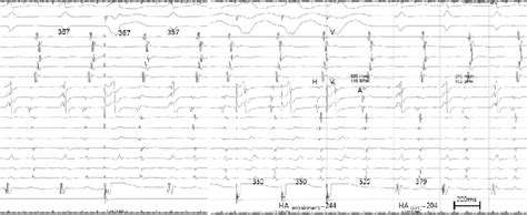 Ablation Of Atypical Atrioventricular Nodal Reentrant Tachycardia A