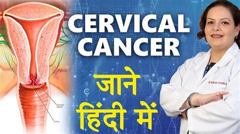 Cervical Cancer In Hindi गरभशय कसर जन हद म Dr Shikha