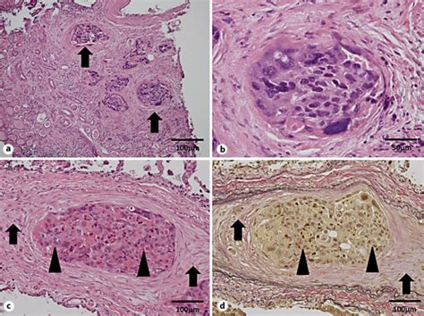 Pathological Findings Low Power Field A And High Power Field B Of Download Scientific